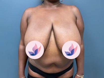 breast reduction slider