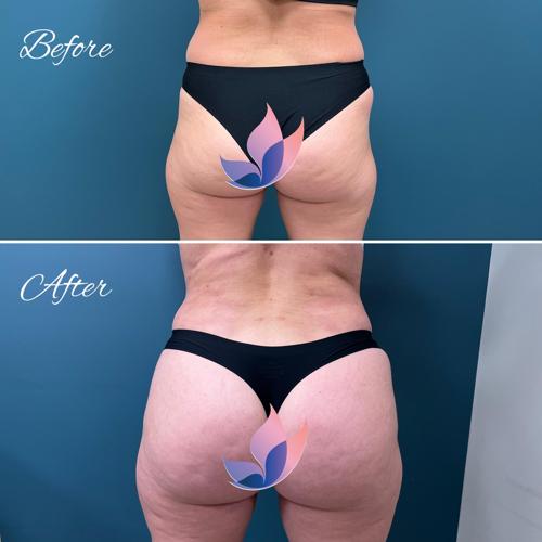 Brazilian Butt Lift Lexington, KY