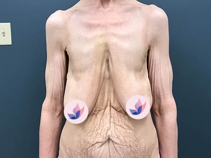 breast lift slider